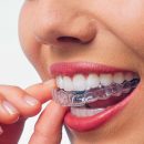 Капи на зуби або металеві брекети: що обрати?