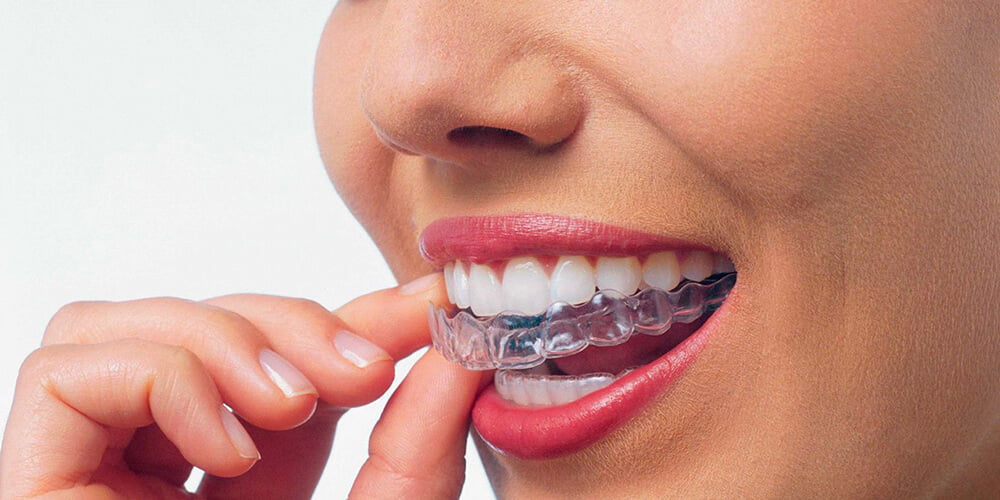 Капи на зуби або металеві брекети: що обрати?
